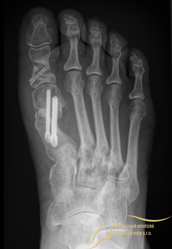 Post-operative x-ray of right foot